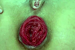 Watch the destroyed anal prolapse up close in this extreme play.